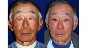 Asian Eyelid Surgery: See These Post-Op Photos  Years After Surgery