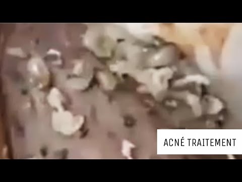 Extraction point noir, acné, kyste en profondeur #8