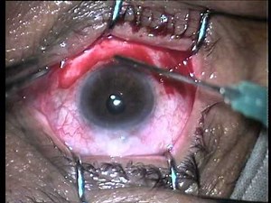 conjunctivochalasis surgery with narration Dec 2013