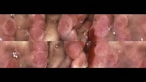 Have you seen the latest #DDW2021 ASGE real case video? Watch...