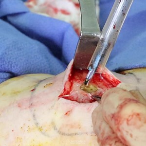 Removal of Seroma from Knee (GRAPHIC)
