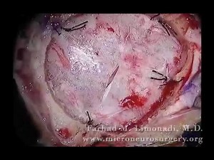Brain Surgery - Removal of Metastatic Tumor High Power Surgical Microscope • Video • MEDtube.net
