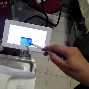 Upper 2nd molar root stumps surgical extraction case# dental treatment in govt hospital in village