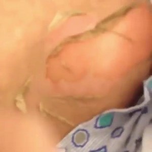 1.3K views | Positive Nikolsky sign in a patient with Toxic Epidermal...