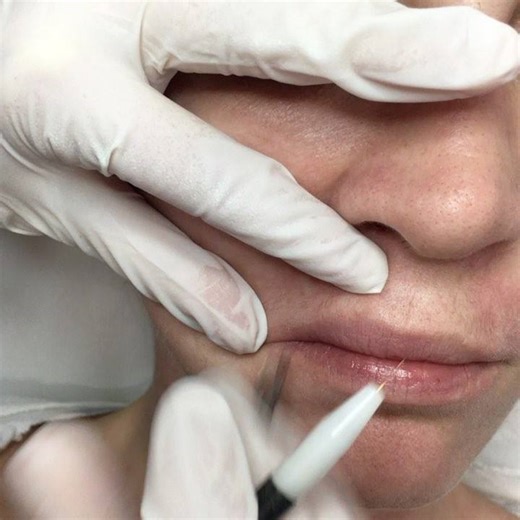 İğneli epilasyonda son teknoloji Apilus Xcell pro cihazımız ile ağrısız ve acısız epilasyon artik mümkün! \u00100 kesin çözüm istiyorsaniz mutlaka iğneli epilasyon ile tanışın👍🏼 Ayrıntılı bilgi için bizi arayın☎️ 0216 363 53 64-67 #igneliepilasyon #igneliepilasyon #iğneliepilasyon #sonteknoloji #agrisizacisiz #cindycadde #bagdatcaddesi #kadıköy #bostancı #caddebostan #güzellik #güzellikmerkezi #bakim | Cindy Güzellik Salonu