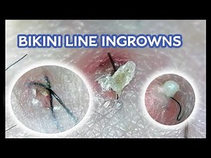 Satisfying Bikini Line Ingrown Hairs #2! (20 MINUTES OF INGROWNS)