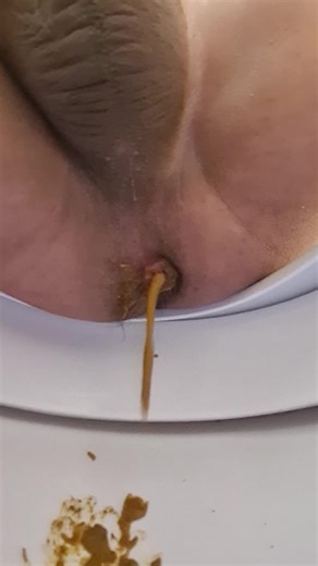 From logs to massive diarrhea and lots of watery farts