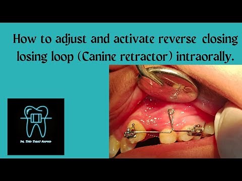How to adjust and activate reverse closing loop ( canine retractor) intraorally | Space Closure