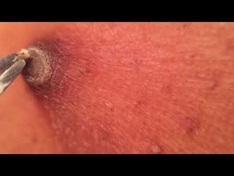 PART 2- Dilated Pore scab - Full extraction