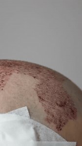 Guérison Après Greffe, Récupération Du Cuir : vidéo de stock (100 % libre de droit) 3981895641 | Shutterstock