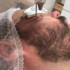 3K views · 42 reactions | Erbium laser peel $300 (full face) Erbium Laser Peel: ✅Stimulates collagen production ✅Reduce scarring including acne scarring ✅Diminishes lines and wrinkles ✅Skin tightening ✅Sun damage ✅Skin rejuvenation ✅Removal of pigmentation ✅Smoothing skin | Newcastle Cosmetic Doctor | Facebook