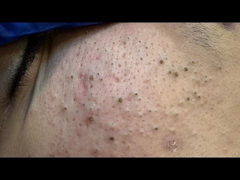 DERMATOLOGY 7 TIPS FOR ACNE TREATMENT - Doctor's Guide