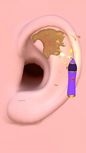 39K views · 48 reactions | Giant Earwax vs Laser: Deep Cleaning Animation #earcleaning #animation #reelsfacebook #satisfying #asmr Tunnig ASMR | Tunnig ASMR | Facebook