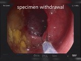 Huge Colonic IS Polyp Clip Assisted Resection • Video • MEDtube.net