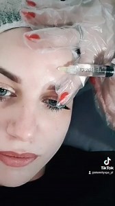 💉💉💉Mezoterapia igłowa jest zabiegiem medycyny estetycznej, który ma na celu dostarczenie skórze substancji nawilżających, odżywczych i regenerujących.💉💉💉💉 Wnikając głęboko w warstwy skórne, powoduje poprawę jej wyglądu. Regeneruje, ujędrnia, spłyca zmarszczki i redukuje niedoskonałości. Zabieg wykonywany jest na niemal każdym obszarze ciała, jednak do najbardziej popularnych miejsc należą twarz, szyja, dekolt, dłonie i owłosiona skóra głowy. Oprócz efektu odmłodzenia mezoterapia igłowa za