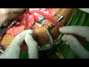 Infra Renal Abdominal Aortic Aneurysm Repair • Video • MEDtube.net