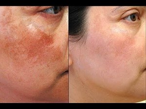 Remove dark spots, freckles, pigmentation, and Acne scars