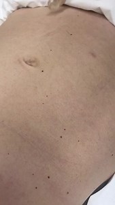 Cherry Angiomas are very common skin growths that often grow on the...