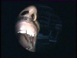 Erosive Buccal Lichen Planus • Video • MEDtube.net