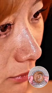 1.4M views · 4.9K reactions | Remove Blackheads & Whiteheads Easily At Home . . . #removeblackheads #blackheads #whiteheads #removeblackhead #Homeremedy #natural #fbreelsfypシ゚ #reelsfbシ #fypviralシ #reelsforyou #reelschallenge | YourBeauty Tv | Facebook