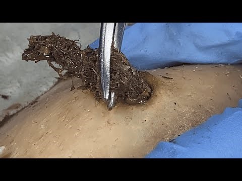 Dr. Lee Blackhead Removal without Extractor Tool! Big Cystic Acne Blackheads 1011m2 0842