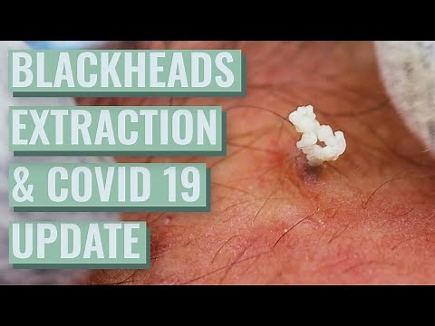 Amilios Blackheads Extraction Session 2 part 2 + Covid 19 Update