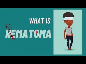 What is a hematoma?, Hematoma impaired wound healing