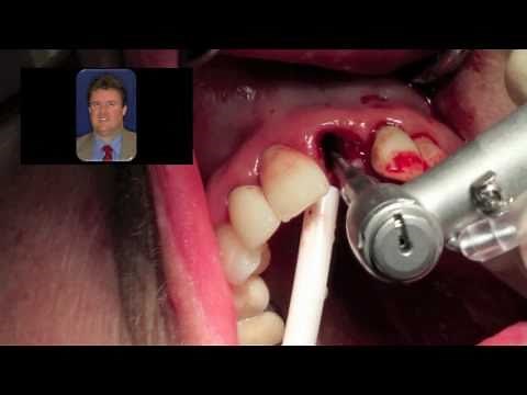 Immediate Dental Implant Surgery - Dr Scott MacLean Front tooth