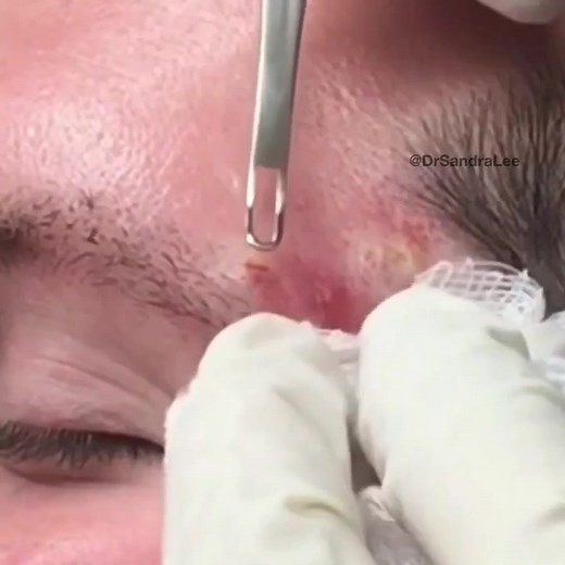 Extraction of whiteheads aka closed comedones using a schaumberg type ... | white heads