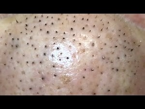 'Black hair acne' (oxidised sebaceous filaments?)