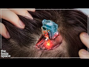 New Brain Implant Begins Human Trials - Neuralink Update!