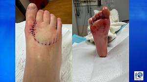 Four ‘marine life’ bites in Virginia Beach this past week, officials confirm