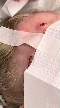 Dr. B shows removal of cancer on forehead #mohs #cancerremoval