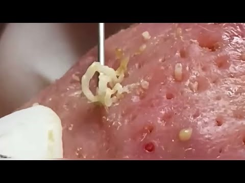 Blackheads, Whiteheads, Huge Pores! Cystic acne, Pimple popping.
