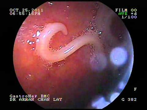 Ascaris ("roundworms")