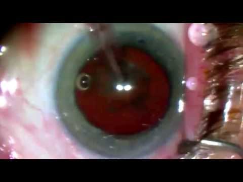 Learning Vertical Chop With The Seibel Vertical Chopper