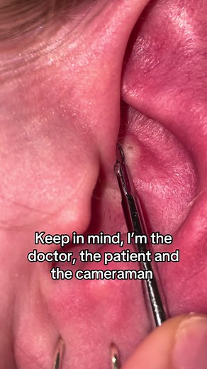 Satisfying Blackhead Removal by a Doctor