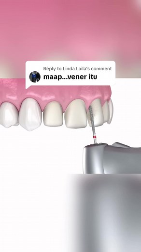 Manfaat Veneer Gigi Tanpa Kikis di VINIR