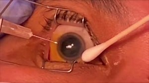 How do you reduce the risk of inadvertent #lens touch in #phakic patients during an anterior chamber paracentesis procedure? Clinical knowledge is constantly evolving. Stay current with Section 9 of the new BCSC: #Uveitis and #Ocular Inflammation. https://ow.ly/r0qH50PWhF5 | American Academy of Ophthalmology