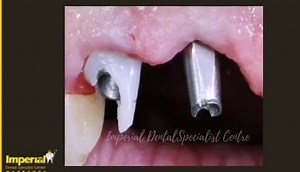IMPLANT CEMENT RETAINED: Why cement retained? For aesthetic prostheses:✨✨✨ Cement retained have no holes and therefore, are aesthetically superior in most instances.” The resulting appearance is more like that of a natural teeth as shown in video | Imperial Dental Specialist Centre | Facebook