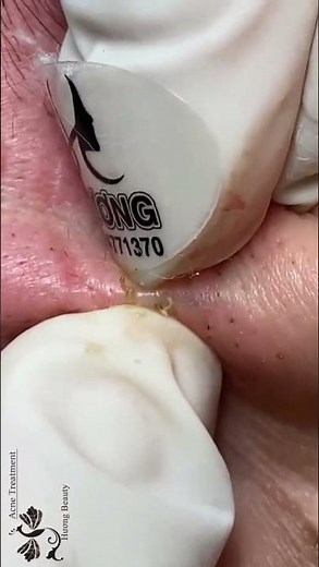 Pimple Popping 2021 - Blackheads & Whiteheads #269