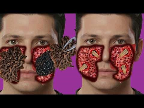 Satisfying Maggot Removal ASMR Animation | Deep Skin Extraction & Relaxing Cleanup