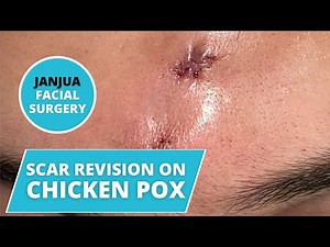 CHICKEN POX SCAR REMOVAL ON MALE FROM ALABAMA - DR. TANVEER JANJUA - NEW JERSEY