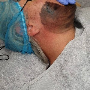 BLACK DIAMOND LASER TREATMENT in progress... * NO pain NO downtime * Only takes 45min * Fantastic acne treatment * Softens wrinkles and fine lines * Reduces pores * Cleans out blackheads and congestion * Makes your skin glow! Email us to book hello@powderpuffmakeup.co.za/ 0843229765 Maryna | Powderpuff Permanent Make-Up