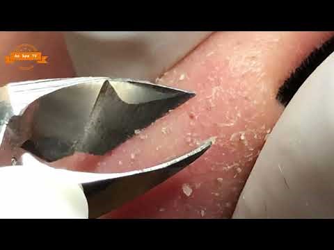 #01 Best Nose Plucking Blackheads Whiteheads Removal | Acne Treatment