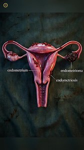 Endometriosis is a chronic and often painful condition where tissue similar to the lining of the uterus grows outside it, commonly affecting the ovaries, fallopian tubes, and pelvic lining. During every menstrual cycle, this tissue thickens and breaks down, but unlike normal lining, it has no way to exit the body, causing inflammation and scar tissue. Symptoms vary but often include debilitating pelvic pain, fatigue, and severe menstrual irregularities. Crucially, "endo" is a leading cause of in