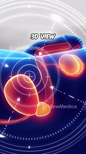 Robot-Assisted Prostate Surgery #prostatecancer #prostatecancertreatment #menshealth #prostatectomy #cancer #prostatecancerawareness #3dmedicaleducation #3danimationsurgery | Viz Medical