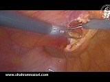 Respektiere die Schicht: Erhalt der Fascia transversalis bei der TAPP-Hernienreparation • Film • Medizinisches Portal de.MEDtube.net