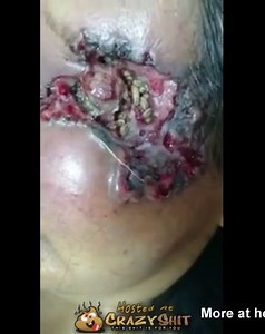 Maggots Eat Eye