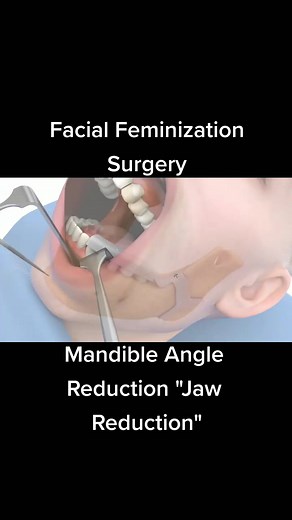 Facial Feminization Surgery: Jaw Reduction Explained